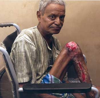 La lepra y otras enfermedades azotan a las clases más desprotegidas de Bombay. Imagen de Guiarte.com