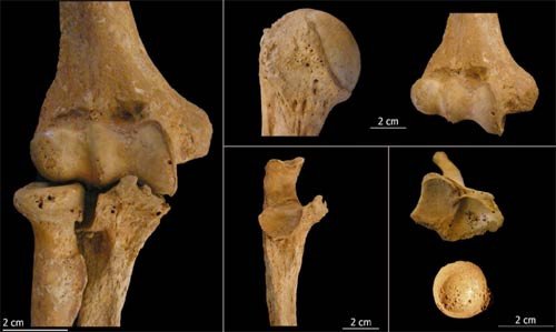 Huesos con evidencias de artrosis, entre la población de la antigua Marialba (León). imagen de la Fundación del Patrimonio